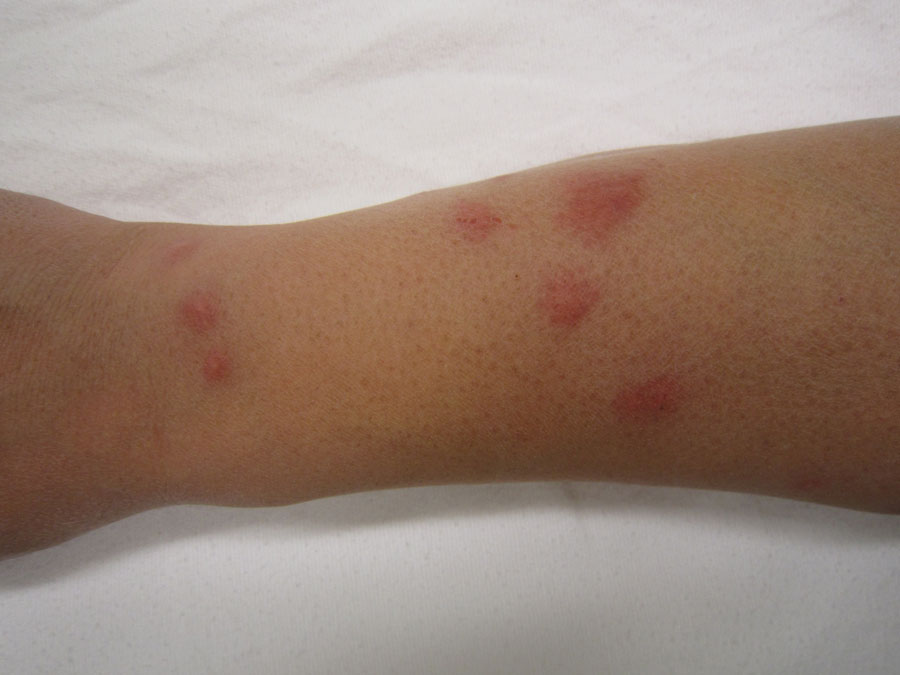 how to identify and prevent bed bugs